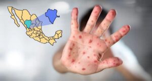 Reportan 185 casos de sarampión en Durango; capital y Mezquital concentran la mayoría