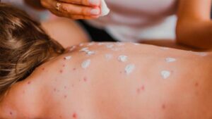 México registra 35 muertes por sarampión y primer fallecimiento asociado a miasis